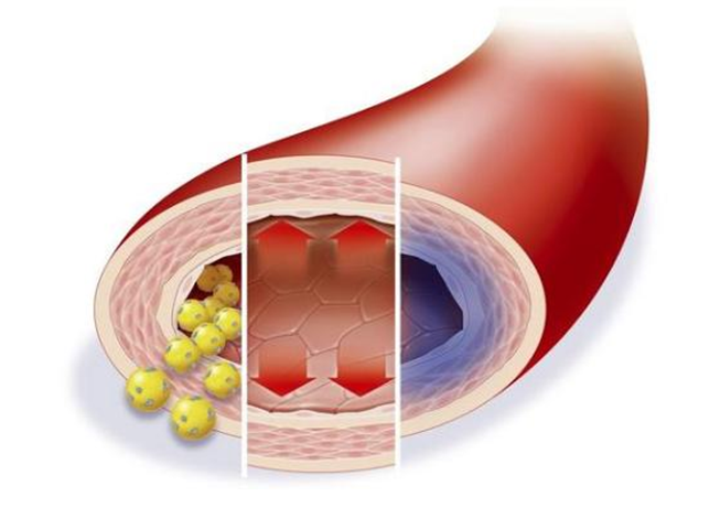 低密度膽固醇超標(biāo)，多久會影響血管健康？來看看鹽城康復(fù)醫(yī)院醫(yī)生怎么說